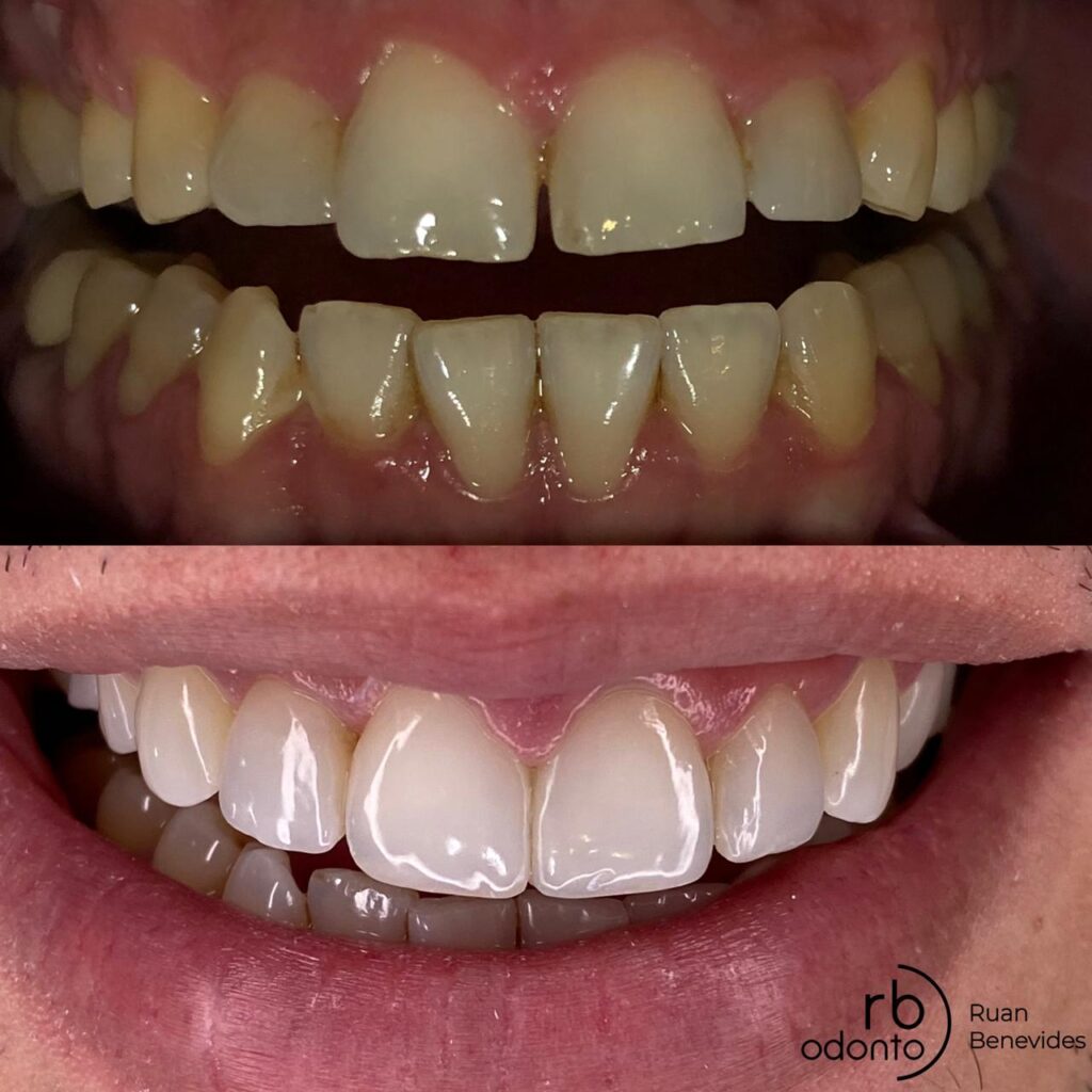 Antes e depois de transformação estética do sorriso