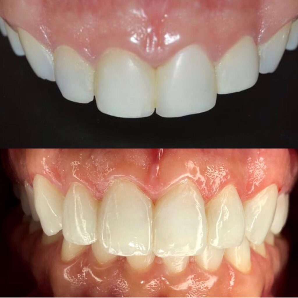 Antes e depois de facetas dentárias