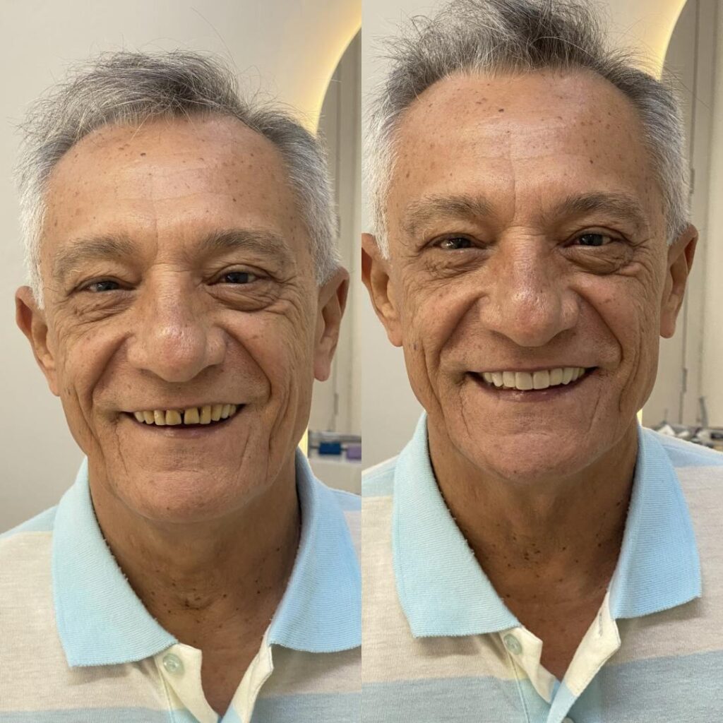Antes e depois de tratamento estético com facetas