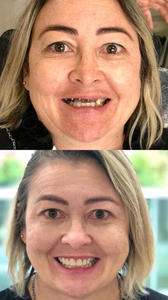 Antes e depois de reabilitação com implantes